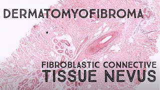 Dermatomyofibroma vs fibroblastic connective tissue nevus mimic of DFSP pathology dermpath [upl. by Renraw]