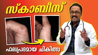 സ്കാബീസ് പരിഹാരം ഉണ്ട് 👍 Scabies treatment malayalam DrSuneefHaneefa scabies scabiestreatment [upl. by Tolmach]