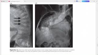 CLINICAL IMAGING OF SPINAL TRAUMA [upl. by Publius339]