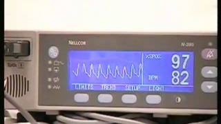 Pulse Oximetry Video [upl. by Verbenia]