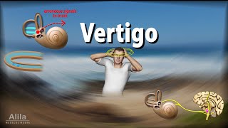 Vertigo Causes Pathophysiology and Treatments Animation [upl. by Osswald]