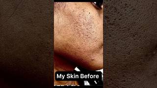 Acne scars Pimple marks Open pores treatment acnescars pimplemarksremoval openporesremedy [upl. by Vinson]