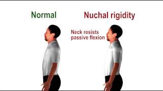 Nuchal rigidity  pathognomonic sign of meningeal irritation [upl. by Harley299]