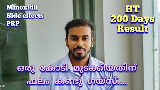 Hair Transplantation Malayalam Review after 6 months  Hair Transplantation Results and Review [upl. by Anailli]