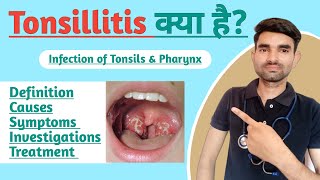 Tonsillitis in Hindi  Causes Symptoms and Treatment of Tonsillitis [upl. by Misab292]