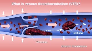 Understanding and Diagnosing Venous Thromboembolism VTE [upl. by Arbrab]