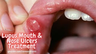 What Is Mouth Ulcer  Mouth Ulcer Symptoms  Mouth Ulcer Causes  What Is Lupus Disease [upl. by Ahseem355]