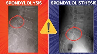 Spondylolysis vs Spondylolisthesis  Definitions Diagrams and Radiographic Appearances [upl. by Erihppas]