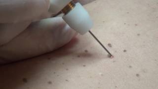 Hyperkeratosis removal with Plexr [upl. by Emsmus322]