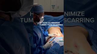 looking to reduce tummy tuck scarring 🙌💙 surgery tummytuck plasticsurgery plasticsurgeon [upl. by Aiykan]