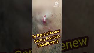 Dermoid cyst removal [upl. by Naened]