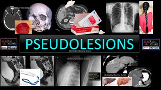 PSEUDOLESIONS [upl. by Nadine426]