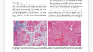 Chronic Liver Failure and Cirrhosis  AcuteonChronic Liver Failure  Liver Pathology pathology [upl. by Michaelina81]