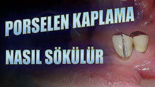 Porselen Kaplama Nasıl Sökülür [upl. by Nylynnej]