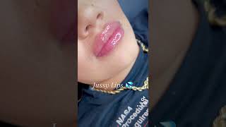 Hyaluron Pen Lips Needle free lip fillers using dermalax deep plus [upl. by Roderica420]