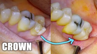 Full Dental Crown Procedure on Molar Tooth Preparation Walkthrough Placement amp Before and After [upl. by Etnoj]