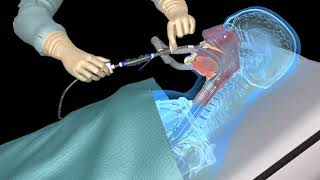 Suctioning the endotracheal tube  medical animation [upl. by Yager922]