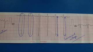 ECG Bifascicular Block  Left Anterior Fascicular Block with Right Bundle Branch Block RBBB [upl. by Evelunn]