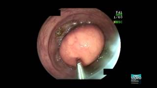 Colonic lipoma [upl. by Bouchard623]