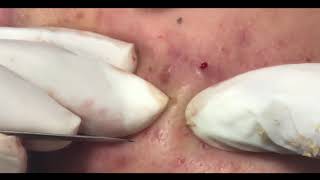 30 MINUTES OF EXTRACTING ACNE [upl. by Erlene]