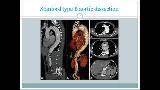 Cardiac CT scan  3D CT angiogram basic overview use contrandications findigns for USMLE [upl. by Gold615]