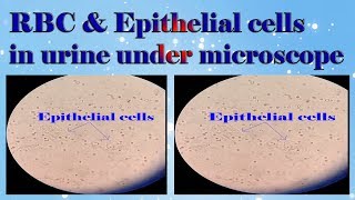 Red blood cells and Epithelial cells in urine under microscope [upl. by Irving]