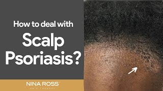 Beat Scalp Psoriasis Tips and Tricks for Relief [upl. by Aisek]