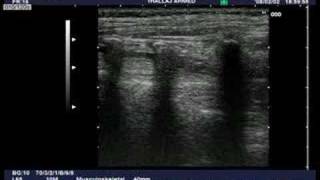 Ultrasound guided caudal block [upl. by Akemehs792]