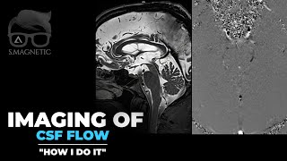 IMAGING OF CSF FLOW – “HOW I DO IT” [upl. by Finah]