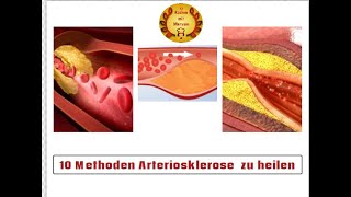 10 Methoden Arteriosklerose auf natürliche Weise zu heilen [upl. by Lorry]