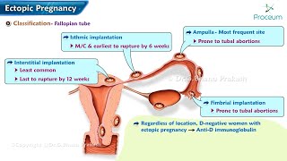 Ectopic Pregnancy Classification Pathogenesis Clinical features Diagnosis amp Treatment [upl. by Nitz781]