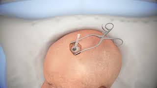 Ventriculostomy Brain Surgery  3d animation [upl. by Ora]