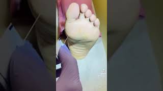 How to do Diabetic foot exam [upl. by Scever766]