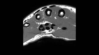 Palmar Fibromatosis Dupuytrens Disease [upl. by Ical]