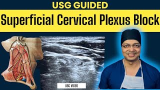 USG GUIDED SUPERFICIAL CERVICAL PLEXUS BLOCK  Cervical plexus anatomy  Real USG video of BLOCK [upl. by Aretse]