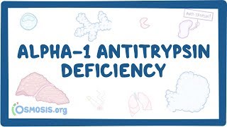 Alpha1 Antitrypsin Deficiency  causes symptoms diagnosis treatment pathology [upl. by Atilahs]