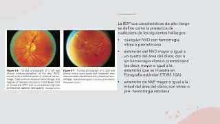 RETINOPATIA DIABETICA Y COREORETINOPATIA SEROSA CENTRAL [upl. by Ardua416]