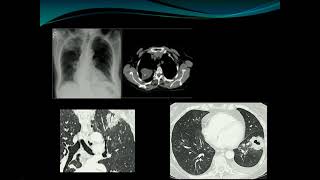 Stratification of lung nodules and the new Fleischner guidelines  Theresa McLoud [upl. by Ginnie]