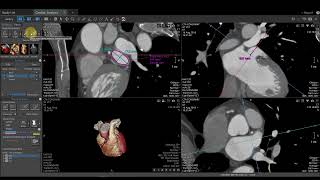 Vitrea Demonstrations  Left Atrial Appendage [upl. by Kippar]