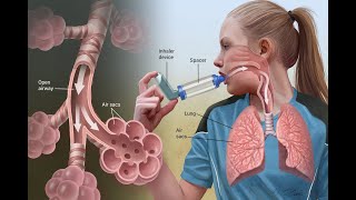 Breathe Easy  Understanding Asthma 6 Minutes [upl. by Joseito]