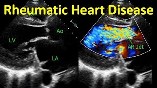 Rheumatic Heart Disease [upl. by Cairns458]