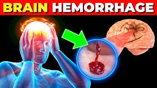 What Happens in Brain Hemorrhage  Symptoms Causes and Treatment [upl. by Swane]