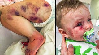 Mom Thought Son Was Stung By Wasp Realizes Truth When He Turns Blue [upl. by Lynnea]