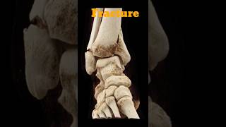 Xray Ankle anklefracture xrayankle shorts fracture radiology education [upl. by Assenay]