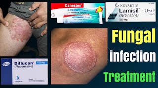 Tinea cruris  how to treat fungal infection  tinea capitis  fungal infection in private parts [upl. by Snook]