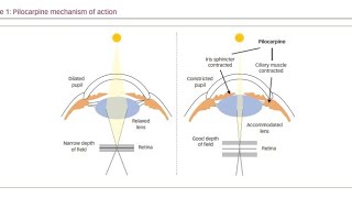 Using Muscarinic Agonist drugs Pilocarpine to treat Glaucoma [upl. by Boehmer]