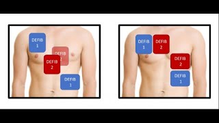 Saving Lives CPR and Double Defibrillation in Refractory Shockable Rhythm [upl. by Sirraf]