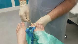 Podiatry nail surgery in 12 minutes to permanently cure ingrown  ingrowing toenails [upl. by Zailer]