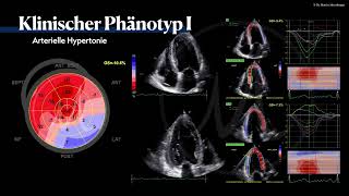 〖Echokardiografie〗 Arterielle Hypertension  HFpEF Phänotyp🫀 [upl. by Moretta]