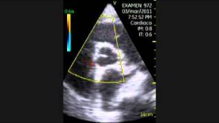 VSCAN Cardiomyopathy of Hypothyroidism Pocket ultrasound Cardiopatía en hipotiroidismo [upl. by Nymsaj]